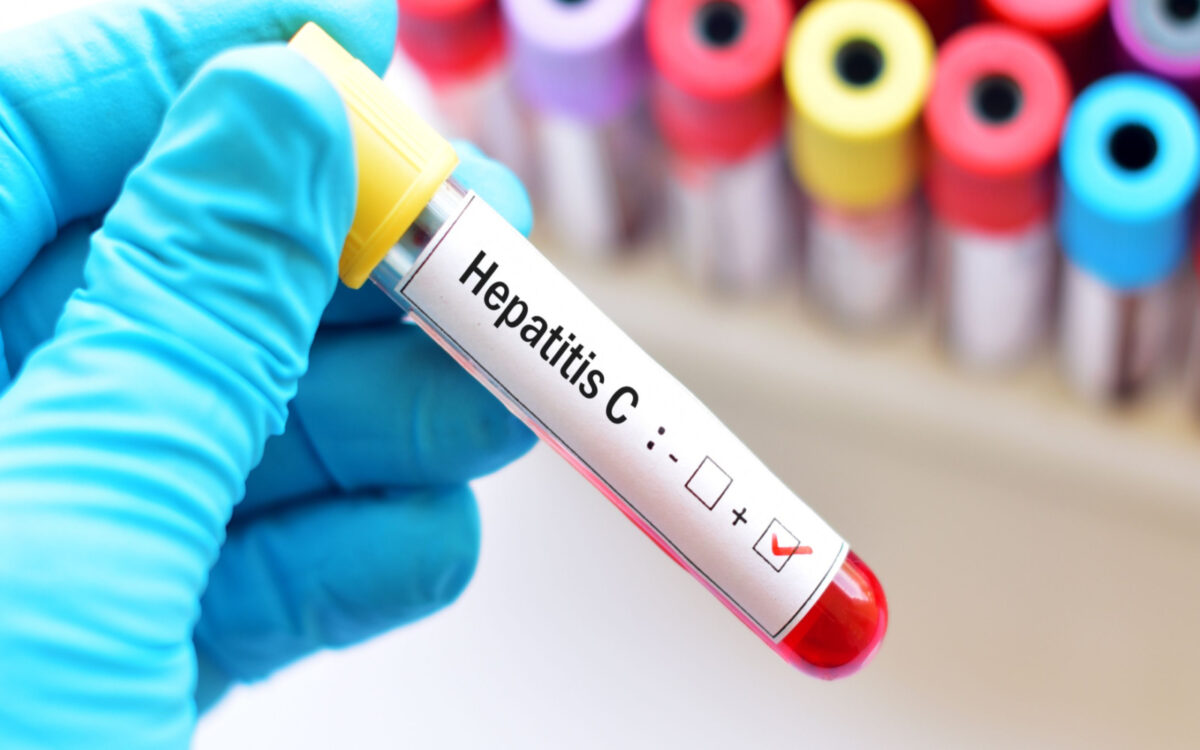Hepatitis C Test Positive